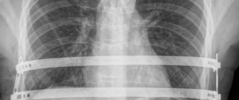 Prótese desenvolvida no Brasil permite melhorar resultados de correção de má-formação do tórax