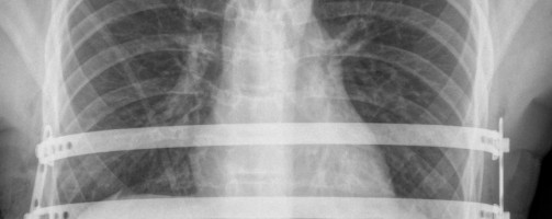 Prótese desenvolvida no Brasil permite melhorar resultados de correção de má-formação do tórax