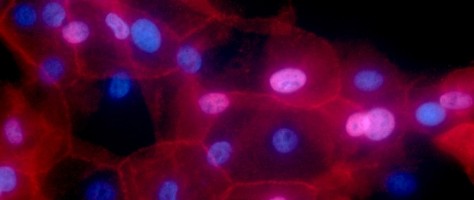 Inteligência artificial auxilia na detecção de câncer de mama a partir de exame de sangue
