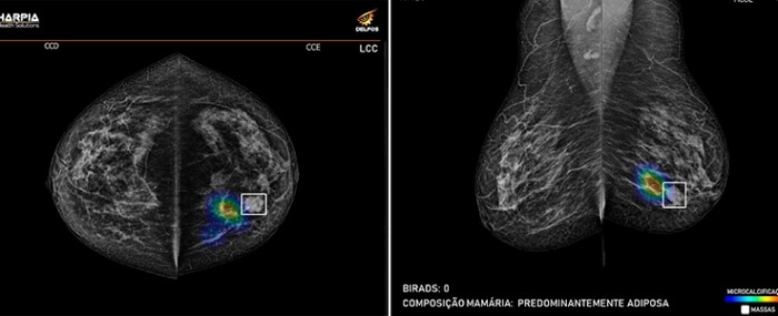 Solução computacional identifica automaticamente alterações em mamografias